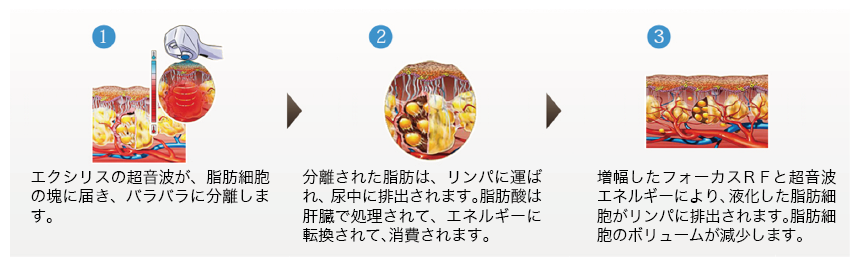 (1)エクリシスの超音波が、脂肪細胞の塊に届き、バラバラに分離します。 (2)分離された脂肪は、リンパに運ばれ、尿中に排出されます。脂肪酸は肝臓で処理されて、エネルギーに転換されて、消費されます。 (3)増幅したフォーカスRFと超音波エネルギーにより、液化した脂肪細胞がリンパに排出されます。脂肪細胞のボリュームが減少します。